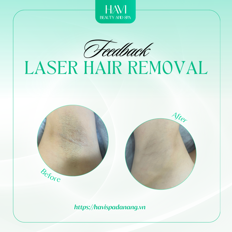 Armpit Laser Hair removal