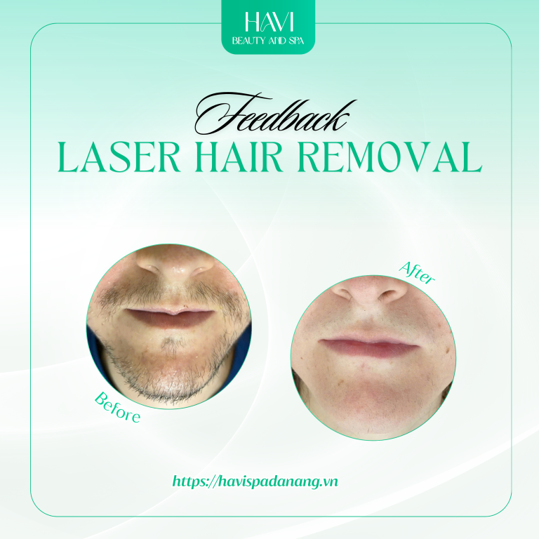 Beard Laser Hair removal