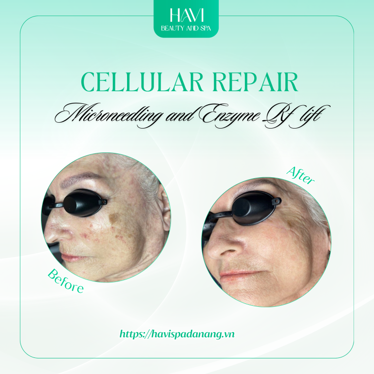 DMK Microneedling