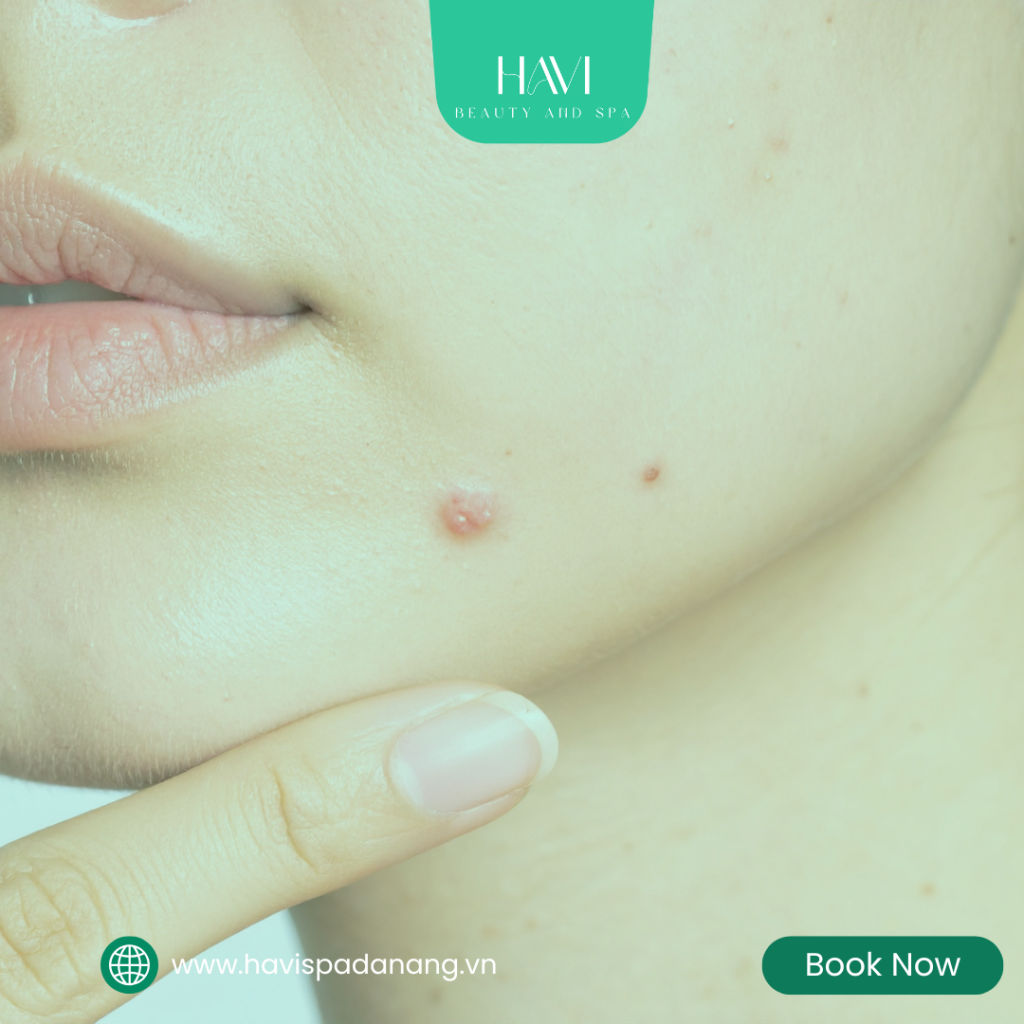 Relaxing acne facial spa experience at Havi Spa Da Nang for clearer and healthier skin.