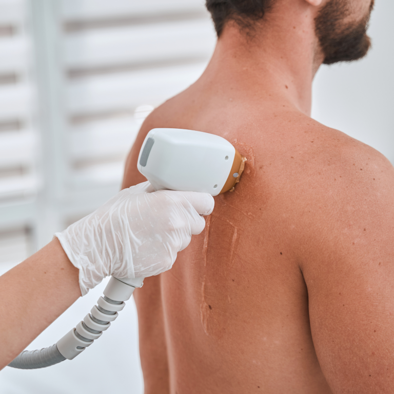 Laser Hair Removal for Women & Men